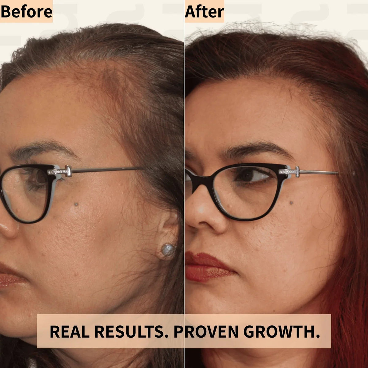 Nicebeam 3-in-1 Scalp Massager before and after graphic comparing a woman's hairline