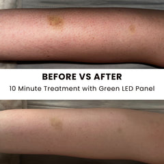 Woman using the Lumara Illuminate Green V1 panel with 525 nm and 1,800 LED specifications