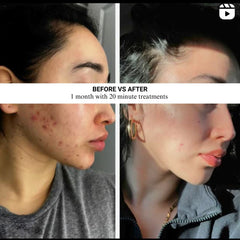 Lumara VISO full face LED coverage compared with a lower density mask