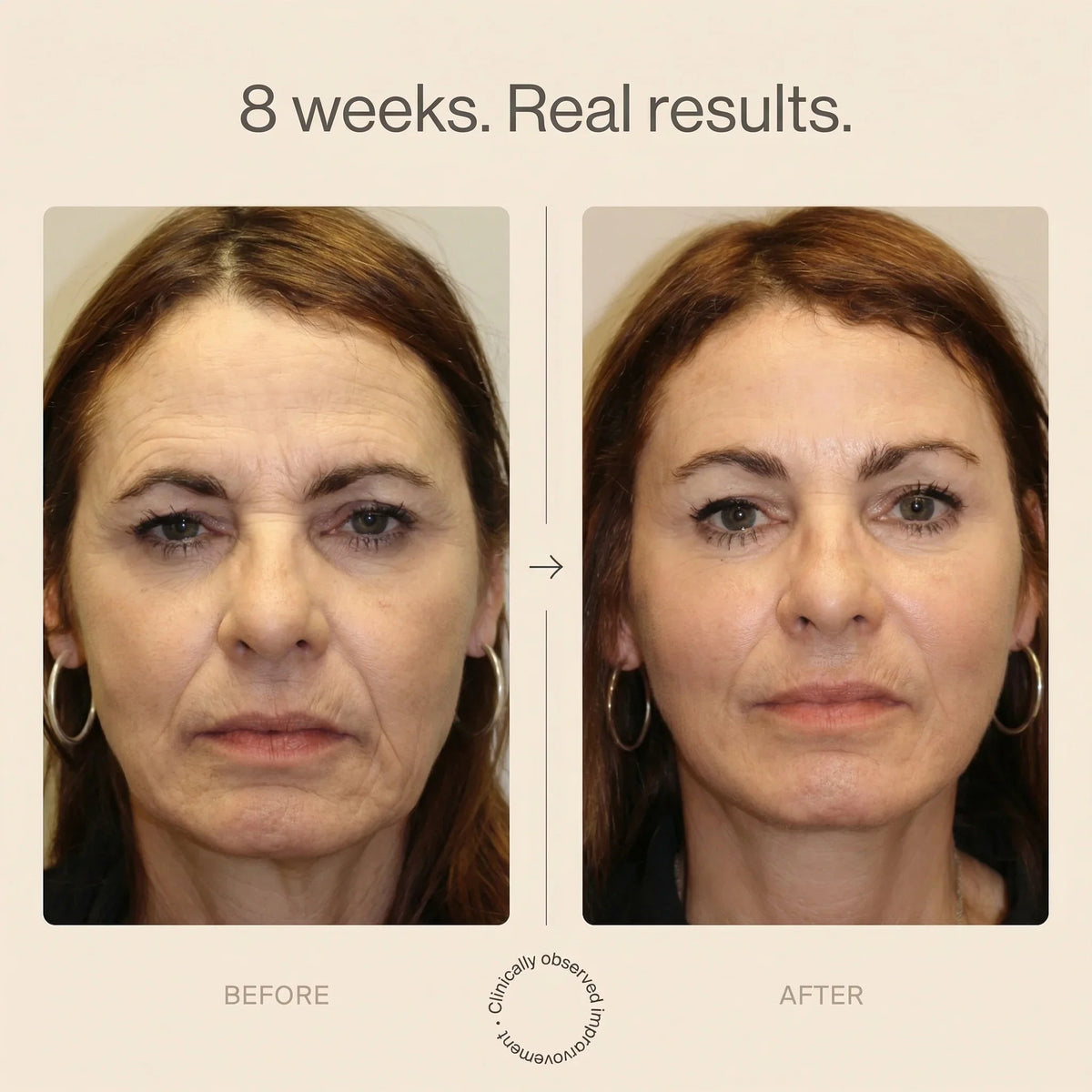 Eight week before and after facial appearance comparison featuring an adult woman