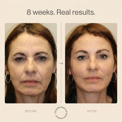 Eight week before and after facial appearance comparison featuring an adult woman