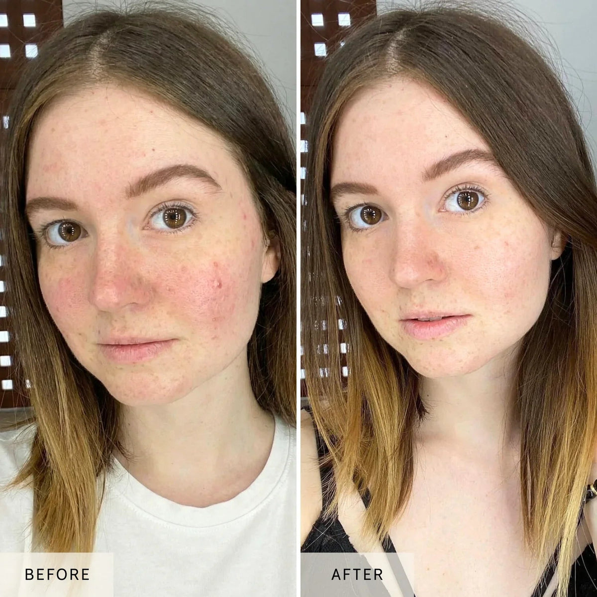 Before and after facial appearance comparison featuring a young woman with visible redness
