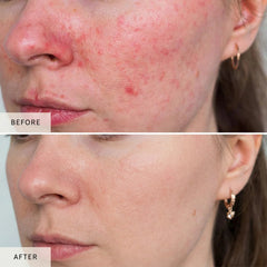 Before and after close up comparison of facial redness